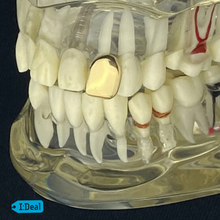 Load image into Gallery viewer, 10k-24k Yellow Gold + Platinum and Silver 1,2,4,6,8 Teeth Top And/Or Bottom
